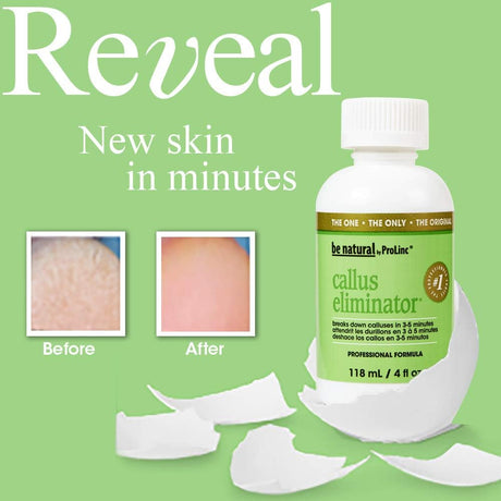 ProLinc Callus Eliminator - 4oz